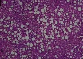 Liver with steatosis - H&E staining